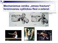 (PDF) Traumatická spondylolistéza L5-S1 - akutne.cz · Traumatická ...